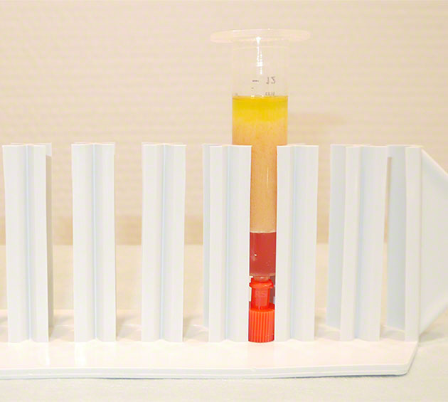 Eigenfettunterspritzung im Gesicht